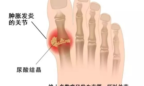 痛风病人能吃鸡蛋吗-痛风病人能吃鸡蛋吗专区_痛风病人能吃木耳吗专区_痛风病人能吃羊肚菌吗网