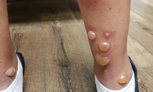 痛风病人能吃鸡蛋吗专区_痛风病人能吃木耳吗专区_痛风病人能吃羊肚菌吗网